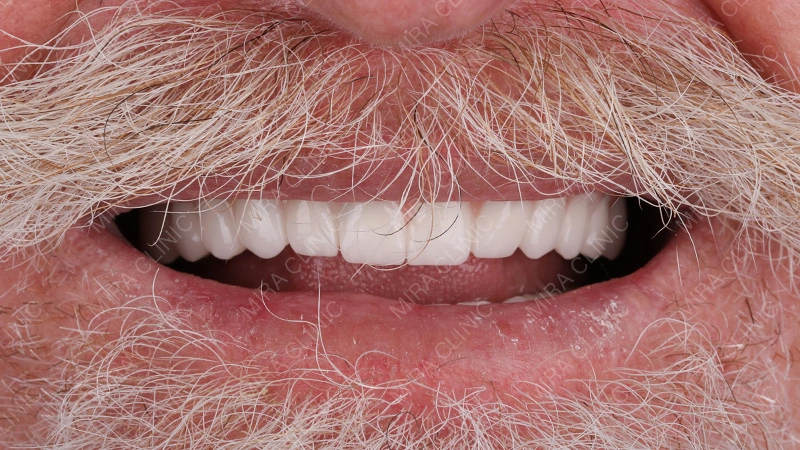 Clinic Experience Dental Implants